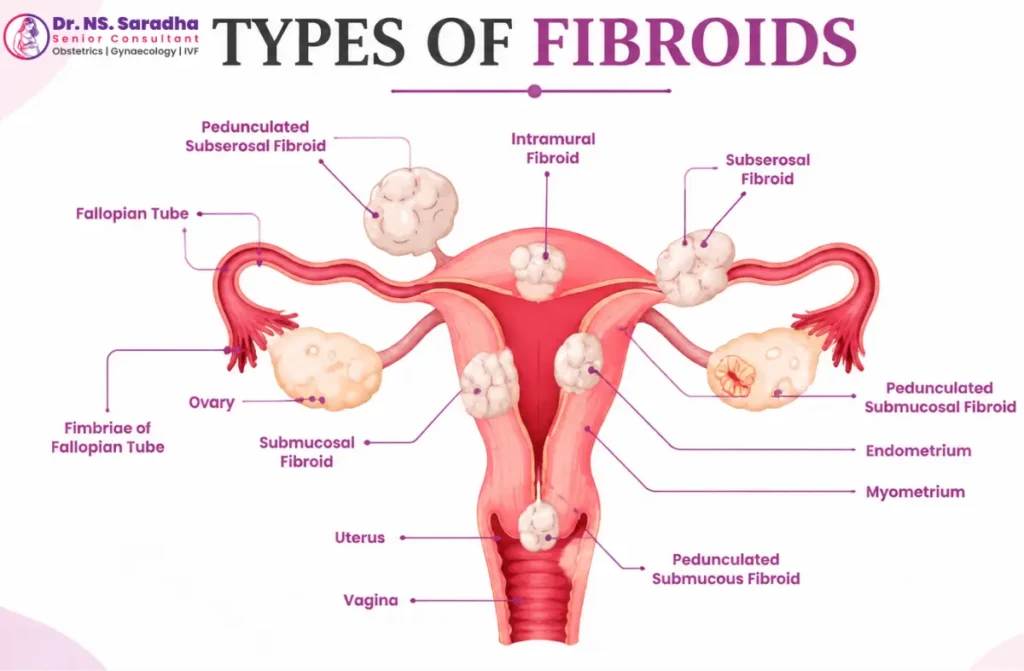 Laparoscopic Surgery for Fibroids